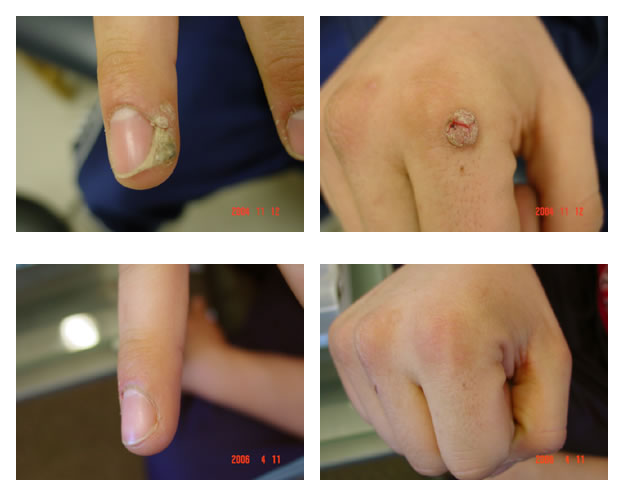 pic of warts on fingers before and after