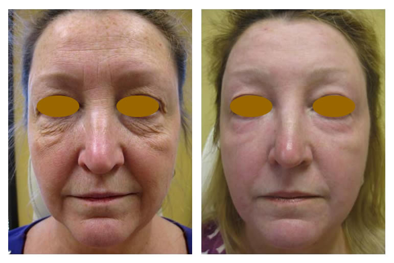 Skin Resurfacing Before and After Photos