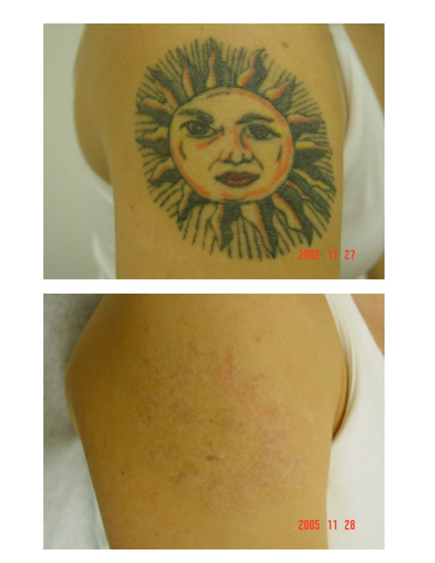 Tattoo Removal - Denver Botox and Juvederm Denver Botox and Juvederm