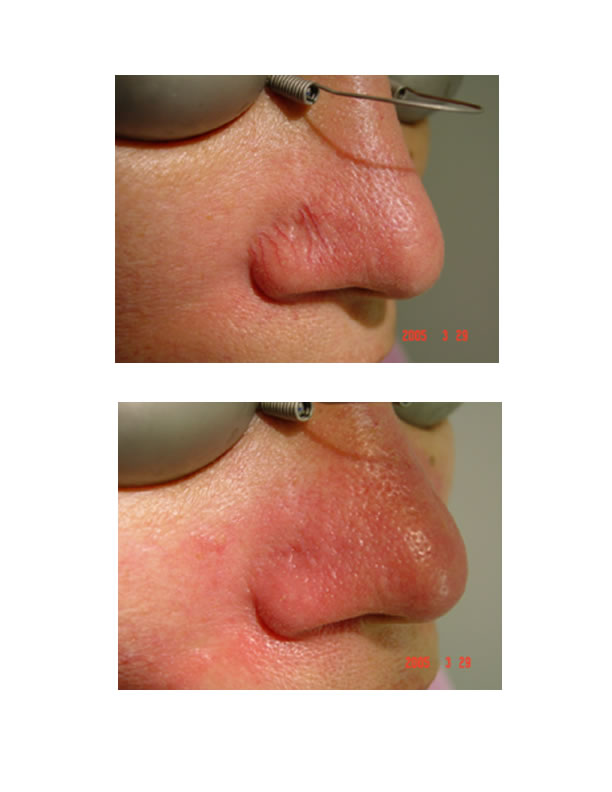 telangiectasia (nose vessels) 3