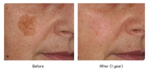 photo - Age spots before and after Laser treatment