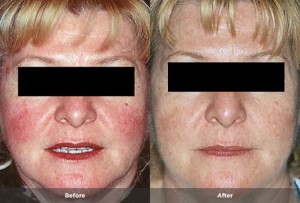 photos Rosacea before and after 