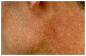 Patient photograph BEFORE Treatment for sun damage (discoloration, heavy freckling, sun spots) to face and neck.