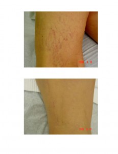 Spider veins on lag before and after