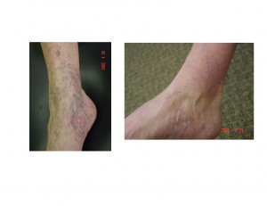 before and after photo of spider veins